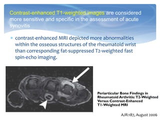  contrast-enhanced MRI depicted more abnormalities
within the osseous structures of the rheumatoid wrist
than corresponding fat-suppressed T2-weighted fast
spin-echo imaging.
Contrast-enhanced T1-weighted images are considered
more sensitive and specific in the assessment of acute
synovitis
AJR:187, August 2006
 