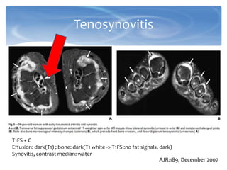 Tenosynovitis
AJR:189, December 2007
T1FS + C
Effusion: dark(T1) ; bone: dark(T1 white -> T1FS :no fat signals, dark)
Synovitis, contrast median: water
 