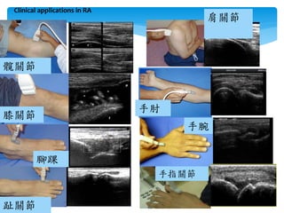Clinical applications in RA
髖關節
膝關節
腳踝
趾關節
肩關節
手肘
手腕
手指關節
 