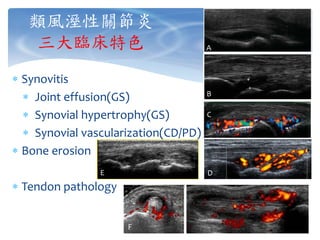 類風溼性關節炎
三大臨床特色
 Synovitis
 Joint effusion(GS)
 Synovial hypertrophy(GS)
 Synovial vascularization(CD/PD)
 Bone erosion
 Tendon pathology
A
B
C
DE
F
 