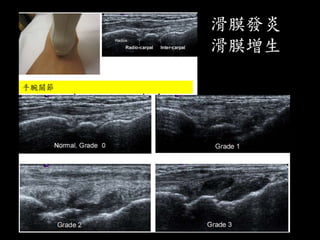 滑膜發炎
滑膜增生
手腕關節
 