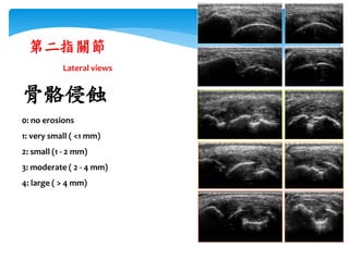 0: no erosions
1: very small ( <1 mm)
2: small (1 - 2 mm)
3: moderate ( 2 - 4 mm)
4: large ( > 4 mm)
骨骼侵蝕
第二指關節
longitudinal
Lateral views
transverse
 