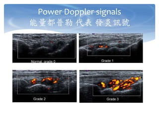 Power Doppler signals
能量都普勒 代表 發炎訊號
 