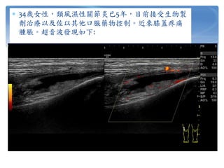  34歲女性，類風濕性關節炎已5年，目前接受生物製
劑治療以及佐以其他口服藥物控制。近來膝蓋疼痛
腫脹。超音波發現如下:
 