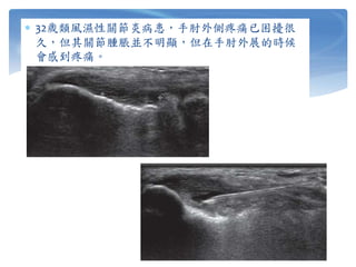  32歲類風濕性關節炎病患，手肘外側疼痛已困擾很
久，但其關節腫脹並不明顯，但在手肘外展的時候
會感到疼痛。
 