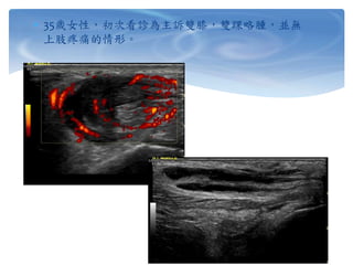  35歲女性，初次看診為主訴雙膝，雙踝略腫，並無
上肢疼痛的情形。
 