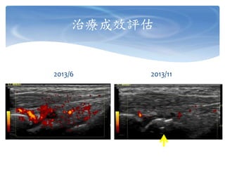 治療成效評估
2013/6 2013/11
 