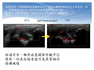 56歲女性，診斷類風溼性關節炎已十多年，服用DMARD及生物製劑，關
節腫痛起起伏伏，但今年初生物製劑開始被減藥。
ESR，CRP 並不高，但病患近日仍主訴手指疼痛益增
5/13 12/4
經過半年，雖然病患關節外觀早已
變形，但是從超音波可見其骨頭仍
持續破壞
Right hand 2nd MCP
 