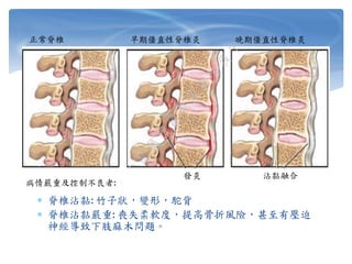 正常脊椎 早期僵直性脊椎炎 晚期僵直性脊椎炎
發炎 沾黏融合
病情嚴重及控制不良者:
 脊椎沾黏: 竹子狀，變形，駝背
 脊椎沾黏嚴重: 喪失柔軟度，提高骨折風險，甚至有壓迫
神經導致下肢麻木問題。
 