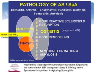 [image tool: MRI]
modified by Medscape Rheumatology education, Expanding
the spectrum for TNF antagonist: Safty & Efficacy in the
Spondyloarthropathies: Ankylosing Spondylitis
Image tool: MRI,
Ultrasound
 