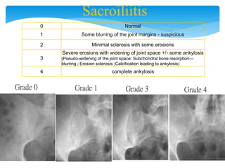 Sacroiliitis
0 Normal
1 Some blurring of the joint margins - suspicious
2 Minimal sclerosis with some erosions
3
Severe erosions with widening of joint space +/- some ankylosis
(Pseudo-widening of the joint space: Subchondral bone resorption—
blurring ; Erosion sclerosis ;Calcification leading to ankylosis)
4 complete ankylosis
Grade 0 Grade 1 Grade 3 Grade 4
 