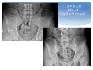 20歲年輕女性，
HLAB27+
相隔四年的X光片
 