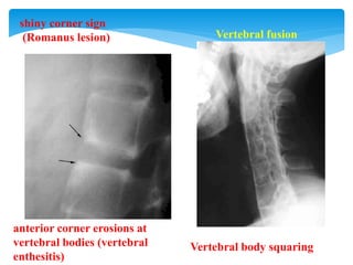 anterior corner erosions at
vertebral bodies (vertebral
enthesitis)
shiny corner sign
(Romanus lesion)
Vertebral body squaring
Vertebral fusion
 