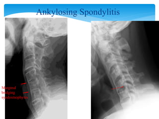 Ankylosing Spondylitis
Marginal
bridging
syndesmophytes
 