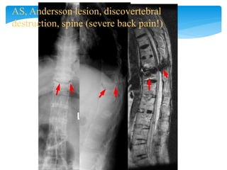 AS, Andersson lesion, discovertebral
destruction, spine (severe back pain!)
 