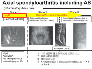 2～5年 Modified New York criteria 1984
1. 下背痛僵硬 休息無法減輕 三個月以上
2. 腰椎活動範圍受限
3. 擴胸範圍受限
4. X光有薦腸關節炎雙側2級或單側3級以上 4+ 1
or 2 or3
 