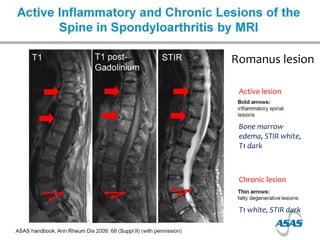 T1 white, STIR dark
Bone marrow
edema, STIR white,
T1 dark
Romanus lesion
Active lesion
Chronic lesion
 