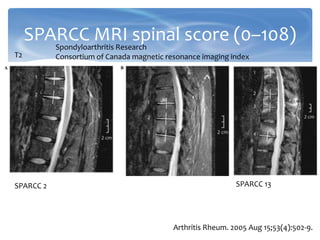 SPARCC MRI spinal score (0–108)
Arthritis Rheum. 2005 Aug 15;53(4):502-9.
T2
SPARCC 2 SPARCC 13
Spondyloarthritis Research
Consortium of Canada magnetic resonance imaging index
 