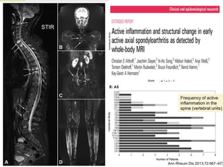 STIR
Frequency of active
inﬂammation in the
spine (vertebral units)
Ann Rheum Dis 2013;72:967–973
 