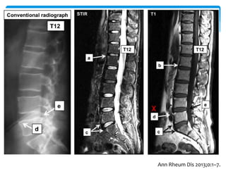 Ann Rheum Dis 2013;0:1–7.
 