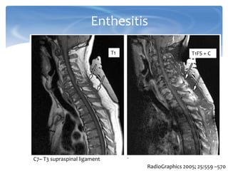 Enthesitis
T1 T1FS + C
C7~ T3 supraspinal ligament
RadioGraphics 2005; 25:559 –570
 