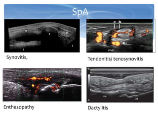  Synovitis,
SpA
Synovitis, Tendonitis/ tenosynovitis
Enthesopathy Dactylitis
 