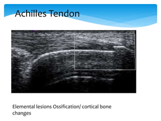 Elemental lesions Ossification/ cortical bone
changes
Achilles Tendon
 