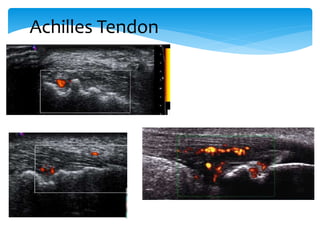 Achilles Tendon
Cortical bone irregularities:
erosion, doppler
 