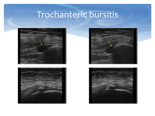 Trochanteric bursitis
 