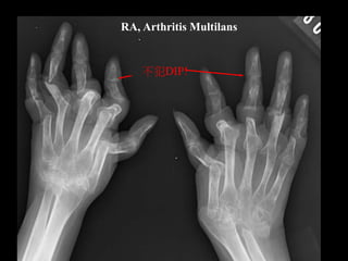 RA, Arthritis Multilans
不犯DIP!
 