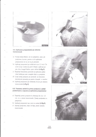 4.4. Aplicarea preparatului pe cirarea
transversali
a) Puned

mini

liberd, ori un pieptene, uqor, pe

porliunea ltrcratd, pentru ca la aplicarea
preparatuiui

si nu se ia pe pensule.

b) Aplicagi preparatul pe niddcine (cca.1,5 cm.)"

in

acest scop conduceqi perii {dingii), apleca$ pe

pirr, de-a lungul firelor, spre.i€rfuri (v.fi9,3).

c) Repetaqi lnmuierea pensulei gi aplicarea pind

dati cu prepacrr.
plepar:lt pe pensula. la inmuiete

c2nd radacina este complet

d) Luagi iareEi

introcluceti pensula pe parrea dreaptd a vasului.
e) Apiicagi prepararul pe ridrciaa, in jos pe cerarea
trunsrrersald (v.fi 9.4).

4.5. Trasarea ciririi in prima porliune a pertii
posterioare a capului gi aplicarea preparatului

a)

impArtigi prima po4iune !a disranga de cca. 1,j
crn. cu o cerare tranwersali.

{iaqi

po4iunea cu

pieptenul.

b) Aplicaqi preparatul aqa cum s-a arerar (v.fi9.5).
c) Agezagi po4iunea, leier, in fagi, pesre cararea
ransversala.

219

-

 