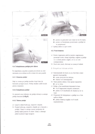 i -ln

--.

I
I

pentru ca pericolul unei rinfi si nu fie mare;
pentru ca func$rmea protectoare a pieligei se
se pefpeileze.

c) Spalali m?na cu apa curata.
4.5. Pcst-tratarea

a)

Perrtru'regresar&r pielii $ pentru regenemrea
proteqiei acide, tratag suprafala unghiei $i pielrti

cu o cremi p€n6u unghii, ori cu un ulei
corcspunzator.

b)
4.4. lndepirtarea pielifei prin

Dacn este cazul, efecn:agi un masai al

€iere
S, ti:r*g*3! €€

ln majoritatea cazurilor

ace"'asti,

necesara Ei ea trebuie sa fie

miinii.

proceduri nu

evitat cit

tf*brlis *e!qdt*

este

a)

este posibil.

lnstrurnentele de lucru nu au fost intr-o stare

igienici ireproqabiltr:

I
I

4.4.{. Grsaaraa pielilei
Dalr cu crefle pe pielip irnediat dupn baia de

b)

pentru trltament.

I
t

?nmuiati in baie:

vor fi iogreunate etapele urrnitoare;
pielea va fi insuficient de elastica gi se va

rupe.

Cu aiutorul unui ridicatcr de pie$a ridicagi cu atengie

d)

pielip inmuiat'a tv.fig.8).

Preparatul de indepartare a pieligei nu a fosr
aplicat dirijat:

I

4.4.3. Tiienra pieliSei

pielea

iriati

zuprasolicitate.

a) Luali in mana forfecuga, respectiv cleqtele.
b) Puneli forfecu;a, respectiv cleqtele pe o laterali a
Tiiali crr atengie numai po4iunea de
ieEitn puemic in afara. Lisagi o distanE

pieligei.

pinf la lesutul irigat

se r.'a virsa.

c) Pielip a fosr insuficient

4;[2. lndepdrhrsa pialifei

pieliEn

clienta va fi nemulfumitd.

Vasul pentru mind a fost atezat nepotrivit:

I

?nmuiere gi dupe ussare. Pieliga ram?ne zrsdel moale

creste pericolul de infec$e;

sanguin:

283

-

Ei

unglia vor fi inutil

 