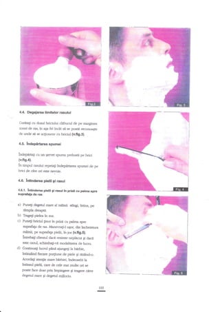 4.4. Degajarea limitelor rasului
Curitagi cu dosul briciului clibucul de pe marginea
zonei de ras, in aga fel incit sd se poati recunoaqte
de unde str se ac[ioneze cu briciul

(v.fig.3].

.

4.5. lndep{rtarea spumei
indepartag crl tur Servet spurna preluatd pe brici
(v.ftg.4).

la timpul rasului repeali lndepilrtarea spumei de pe
brici de clte ori este nevoie.
4.6.. lntinderea ptelll gi rasul

4,6.{. Intinderea pielil gl rusul ln prizi cu palma spre
suprafafia de ras

a)

Puneg

dqeul

rnare al

mainii stingi, intins, pe

tnmpla dreapti.

b) Tragegi pielea ?n sus.
c) Punegi briciul ginut in prizi cu palma

spre

zuprafap de ras. lvlanevragiJ ugor, din lncheienua
mainii, pe suprafap pielii, tn jos (v.fig.S).
lntreba$ clientul dacd resimte neplicut gi daci
este cazul, sdrimba$-ve modalitatea de lucnr.

O

Continuali lucnrl pdnd ajungeg la hirbie,
infinzand fiecare po4iune de piele gi riiznnd-o.
Acordag atengie mare bdtrbiei, indeosebi la
htinsul pielii, care de cele mai muhe ori se
poate face doar prin impingere Si tragere cere
degenrl mare gi degenrl mijlociu.

105

-

 