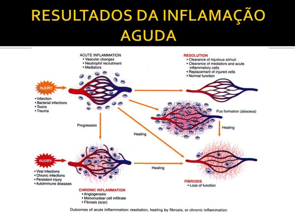 2014916 195915 inflamação+aguda+e+crônica
