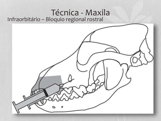 Técnica - Maxila
Infraorbitário – Bloquio regional rostral
 
