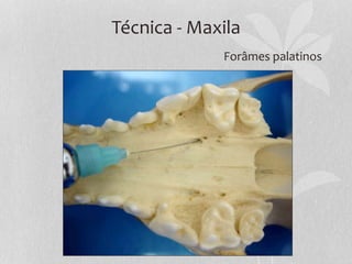 Técnica – Mandíbula
Nervo alveolar inferior
Forâmes mentonianos - Bloqueio regional caudal
 