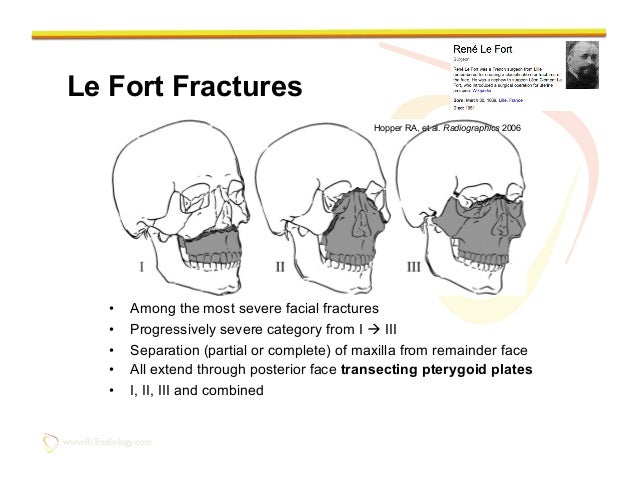 lefort fracture