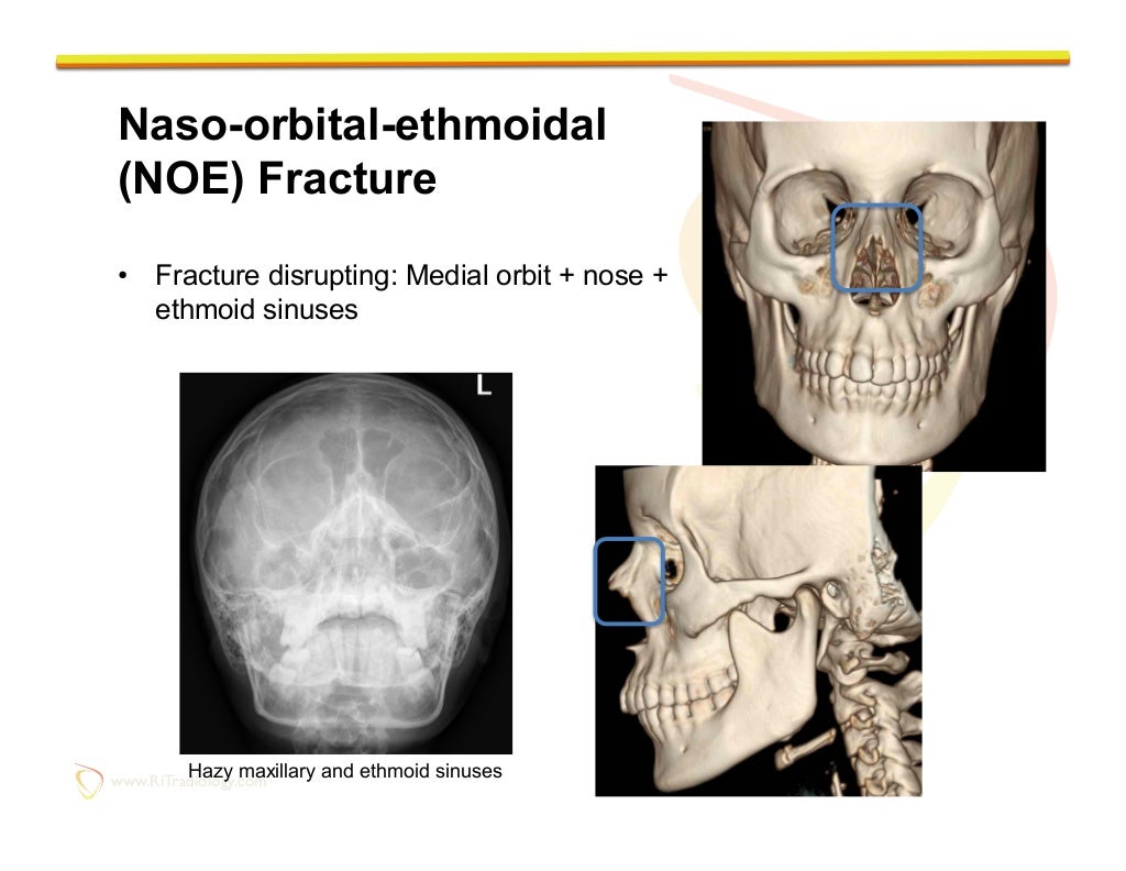 Imaging of Facial Trauma