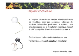 «	
  L'implant	
  cochléaire	
  est	
  desKné	
  à	
  la	
  réhabilitaKon	
  
de	
   l'audiKon	
   chez	
   des	
   person...