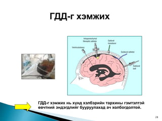 ГДД-г хэмжих
ГДД-г хэмжих нь хүнд хэлбэрийн тархины гэмтэлтэй
өвчтний эндэгдлийг бууруулахад ач холбогдолтой.
28
 
