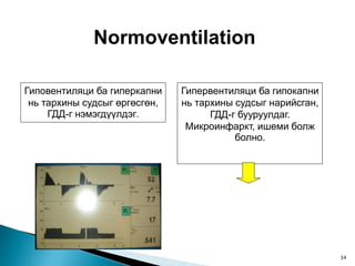Normoventilation
Гиповентиляци ба гиперкапни
нь тархины судсыг өргөсгөн,
ГДД-г нэмэгдүүлдэг.
Гипервентиляци ба гипокапни
нь тархины судсыг нарийсган,
ГДД-г бууруулдаг.
Микроинфаркт, ишеми болж
болно.
34
 