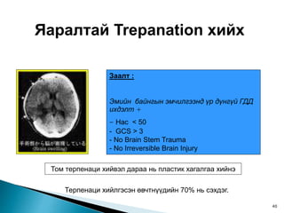 Яаралтай Trepanation хийх
Заалт :
Эмийн байнгын эмчилгээнд үр дүнгүй ГДД
ихдэлт +
- Нас < 50
- GCS > 3
- No Brain Stem Trauma
- No Irreversible Brain Injury
Том терпенаци хийвэл дараа нь пластик хагалгаа хийнэ
Терпенаци хийлгэсэн өвчтнүүдийн 70% нь сэхдэг.
40
 