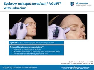 ALFA Injection Guide Consensus, 2013.
Forehead contour: Juvéderm® VOLBELLA®
with Lidocaine
Technical injection recommendat...