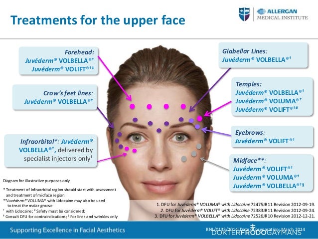 Botox Face Chart