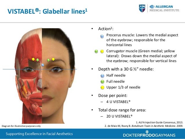 Training for periorbital and upper face treatment with botox and Juve…