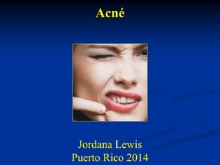 Acné 
Jordana Lewis 
Puerto Rico 2014 
 