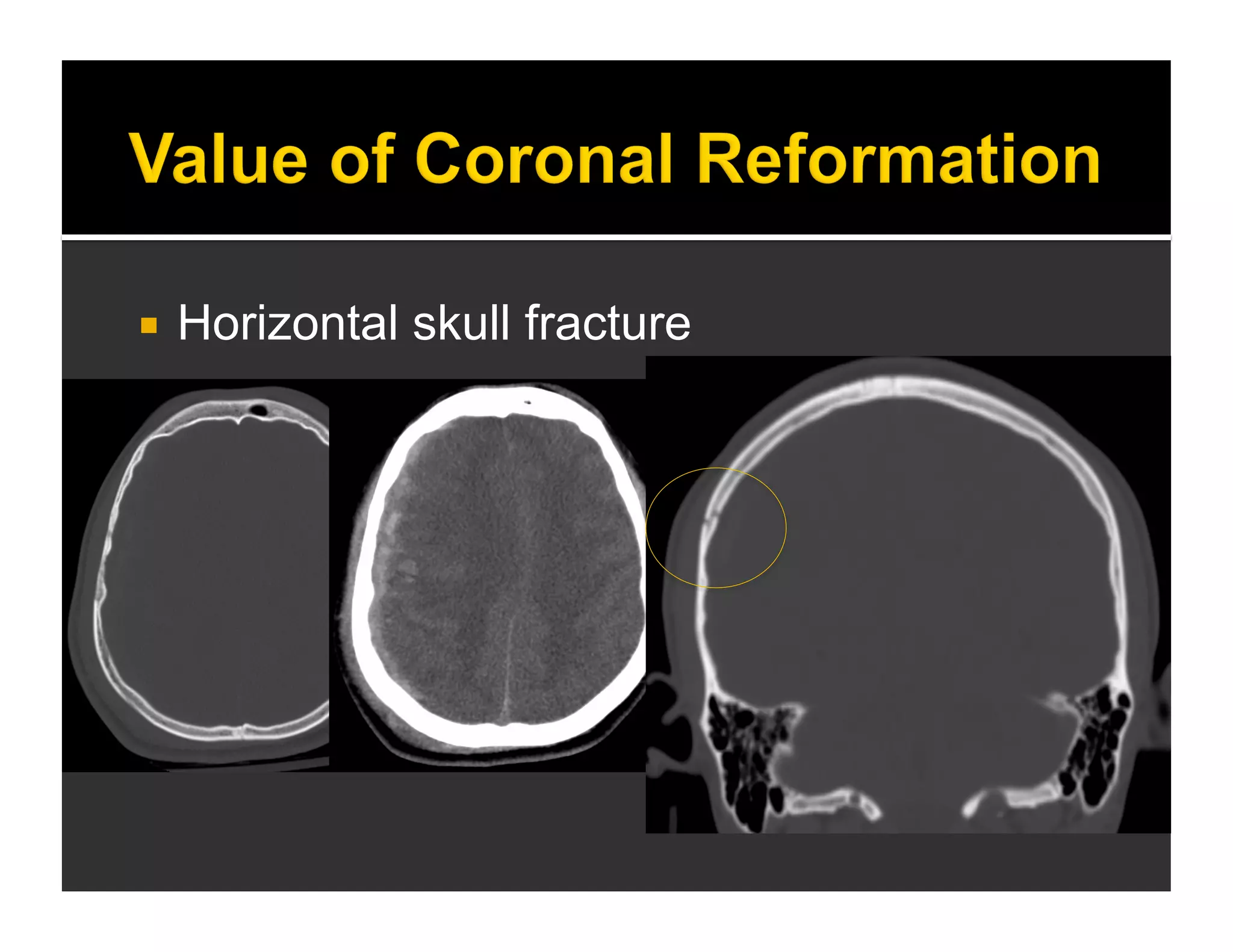  Horizontal skull fracture 
 