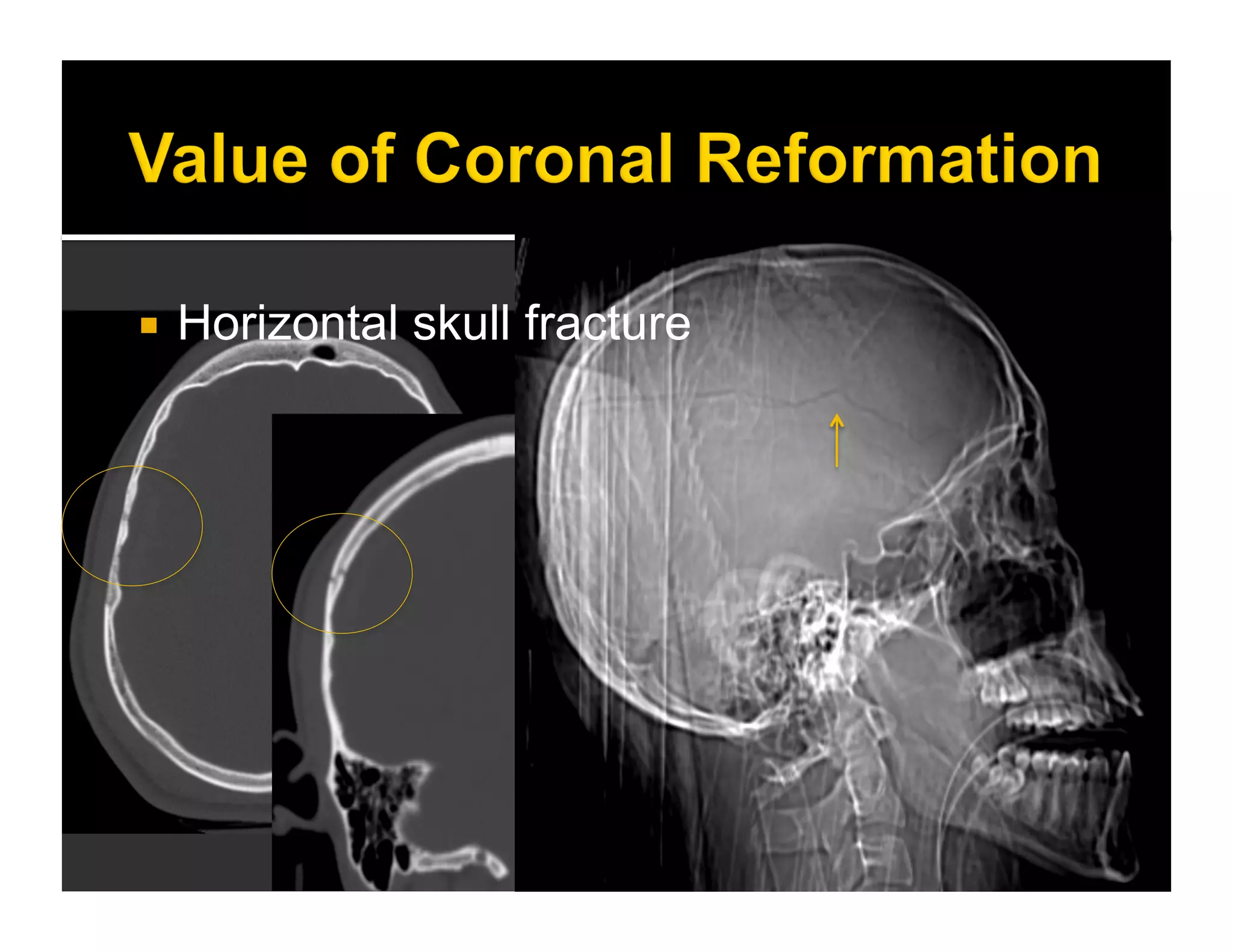  Horizontal skull fracture 
 