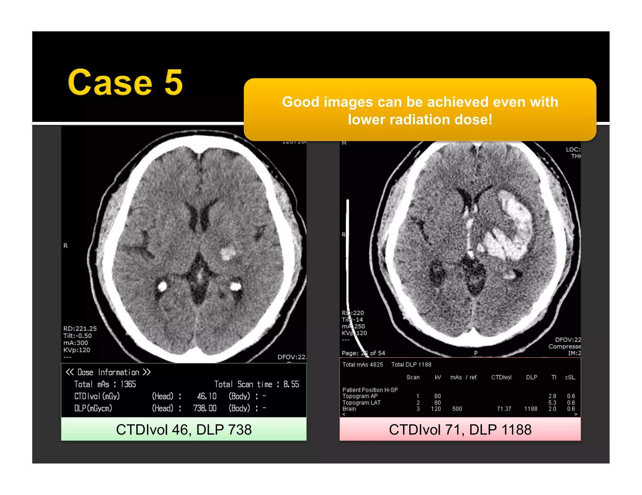 Good images can be achieved even with 
lower radiation dose! 
CTDIvol 46, DLP 738 CTDIvol 71, DLP 1188 
 