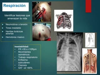 Respiración
 Neumotórax a tensión
 Tórax inestable
 Heridas torácicas
abiertas
 Hemotorax masivo
Identificar lesiones que
amenazan la vida
Inestabilidad:
• FR >35 o <10Rpm
• Movimientos
asimétricos
• Trabajo respiratorio
• Enfisema
subcutáneo
• Cianosis
• SAT o2 <90%
 